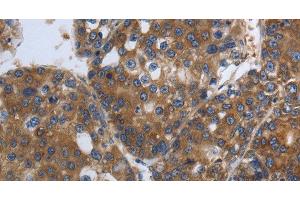 Immunohistochemistry of paraffin-embedded Human liver cancer using SOCS1 Polyclonal Antibody at dilution of 1:90 (SOCS1 anticorps)