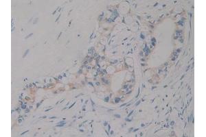 IHC-P analysis of Human Bile duct cancer Tissue, with DAB staining.