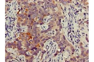 Immunohistochemistry of paraffin-embedded human pancreatic cancer using ABIN7165664 at dilution of 1:100