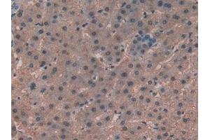 Detection of ALT in Human Liver cancer Tissue using Polyclonal Antibody to Alanine Aminotransferase (ALT)