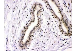 IHC testing of FFPE human breast cancer tissue with NFIA antibody at 1ug/ml. (NFIA anticorps  (AA 180-224))