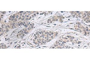 Immunohistochemistry of paraffin-embedded Human colorectal cancer tissue using PPM1K Polyclonal Antibody at dilution of 1:55(x200) (PPM1K anticorps)