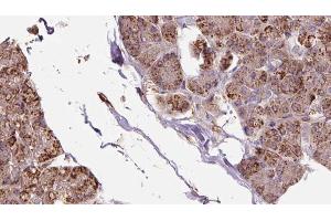 ABIN6273281 at 1/100 staining Human pancreas cancer tissue by IHC-P. (OXA1L anticorps  (C-Term))