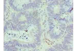 Immunohistochemistry of paraffin-embedded human colon cancer using ABIN7143847 at dilution of 1:100 (ACTR1A anticorps  (AA 187-376))