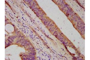 IHC image of ABIN7164376 diluted at 1:500 and staining in paraffin-embedded human colon cancer performed on a Leica BondTM system. (DHX34 anticorps  (AA 418-554))