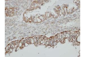 IHC-P Image Immunohistochemical analysis of paraffin-embedded human ovarian cancer, using HSD17B4, antibody at 1:500 dilution. (HSD17B4 anticorps  (N-Term))