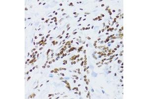 Immunohistochemistry of paraffin-embedded human gastric cancer using NFKB2 Antibody.