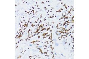 Immunohistochemistry of paraffin-embedded human gastric cancer using NFKB2 Antibody. (NFKB2 anticorps  (AA 690-899))