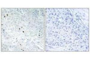 Immunohistochemistry analysis of paraffin-embedded human breast carcinoma tissue, using TP53INP2 antibody. (TP53INP2 anticorps)