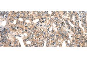 Immunohistochemistry of paraffin-embedded Human liver cancer tissue using GPR55 Polyclonal Antibody at dilution of 1:40(x200) (GPR55 anticorps)