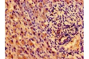 Immunohistochemistry of paraffin-embedded human liver cancer using ABIN7155192 at dilution of 1:100 (TRKA anticorps  (AA 33-208))