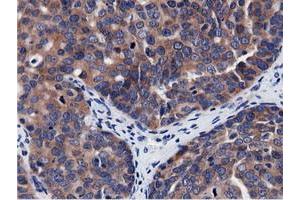 Immunohistochemical staining of paraffin-embedded Adenocarcinoma of Human breast tissue using anti-CBWD1 mouse monoclonal antibody. (CBWD1 anticorps)