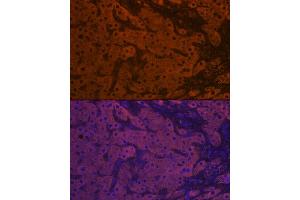 Immunofluorescence analysis of human liver cancer using ApoM Rabbit mAb (ABIN7265646) at dilution of 1:100 (40x lens).