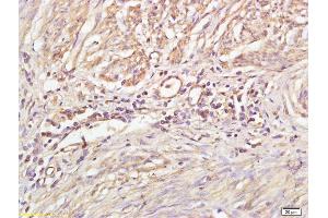 Formalin-fixed and paraffin embedded human cervical carcinoma labeled with Anti-Phospho-PKC gamma (Thr514) Polyclonal Antibody, Unconjugated (ABIN703285) at 1:200 followed by conjugation to the secondary antibody (PKC gamma anticorps  (pThr514))
