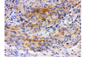 Anti-GAP43 antibody, IHC(P) IHC(P): Human Meningeoma Tissue (GAP43 anticorps  (C-Term))
