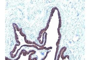 Formalin-fixed, paraffin-embedded human ovarian carcinoma stained with Cytokeratin 8 + 18 antibody (KRT8/803 + KRT18/835). (Cytokeratin 8/18 anticorps)