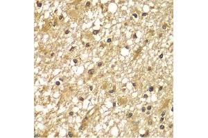 Immunohistochemistry of paraffin-embedded human brain cancer using PIK3R3 antibody (ABIN5975675) at dilution of 1/100 (40x lens). (PIK3R3 anticorps)