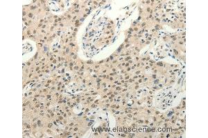 Immunohistochemistry of Human ovarian cancer using FZD10 Polyclonal Antibody at dilution of 1:50 (FZD10 anticorps)
