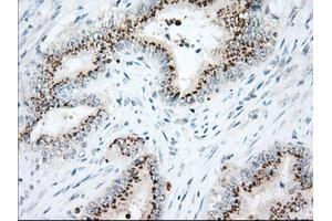 Immunohistochemical staining of paraffin-embedded Adenocarcinoma of Human colon tissue using anti-HSPA1A mouse monoclonal antibody. (HSP70 1A anticorps)