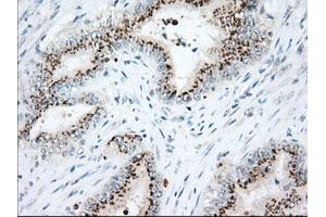 Immunohistochemical staining of paraffin-embedded Adenocarcinoma of Human colon tissue using anti-HSPA1A mouse monoclonal antibody.