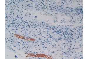 IHC-P analysis of Human Glioma Tissue, with DAB staining. (PEDF anticorps  (AA 21-415))