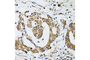 Immunohistochemistry of paraffin-embedded human colon carcinoma using RPN1 antibody.