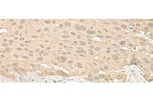Immunohistochemistry of paraffin-embedded Human esophagus cancer tissue using IMPA1 Polyclonal Antibody at dilution of 1:25(x200) (IMPA1 anticorps)
