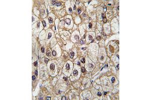 Formalin-fixed and paraffin-embedded human hepatocarcinoma tissue reacted with CYP2C9 antibody , which was peroxidase-conjugated to the secondary antibody, followed by DAB staining. (CYP2C9 anticorps  (AA 235-265))