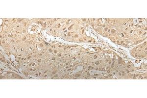Immunohistochemistry of paraffin-embedded Human esophagus cancer tissue using ZBTB18 Polyclonal Antibody at dilution of 1:50(x200) (ZNF238 anticorps)
