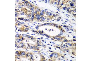 Immunohistochemistry of paraffin-embedded human gastric cancer using RPN1 antibody at dilution of 1:100 (x40 lens). (RPN1 anticorps)