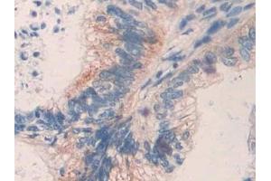 Detection of MMP24 in Human Colorectal cancer Tissue using Polyclonal Antibody to Matrix Metalloproteinase 24 (MMP24)