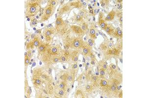 Immunohistochemistry of paraffin-embedded human liver injury using EIF4G1 Antibody (ABIN5975844) at dilution of 1/100 (40x lens). (EIF4G1 anticorps)