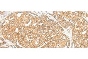 Immunohistochemistry of paraffin-embedded Human liver cancer tissue using DOC2B Polyclonal Antibody at dilution of 1:25(x200) (DOC2B anticorps)