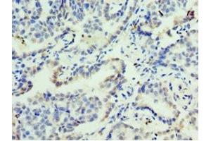 Immunohistochemistry of paraffin-embedded human lung cancer using ABIN7153128 at dilution of 1:100