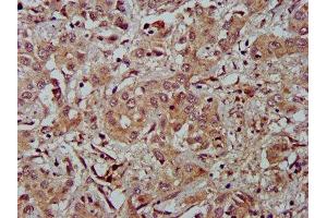 IHC image of ABIN7152919 diluted at 1:500 and staining in paraffin-embedded human liver cancer performed on a Leica BondTM system.