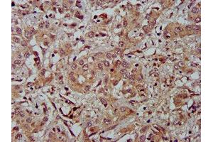 IHC image of ABIN7152919 diluted at 1:500 and staining in paraffin-embedded human liver cancer performed on a Leica BondTM system. (FBLN2 anticorps  (AA 301-440))