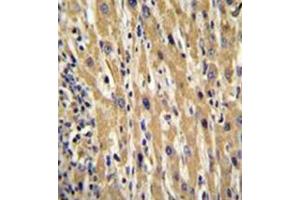 Immunohistochemistry analysis in formalin fixed and paraffin embedded human hepatocarcinoma reacted with Galanin Antibody (Center) followed by peroxidase conjugation of the secondary antibody and DAB staining. (Galanin anticorps  (Middle Region))