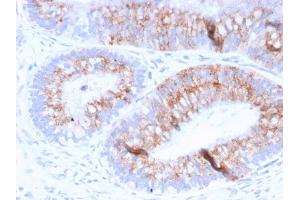 Formalin-fixed, paraffin-embedded human Colon Carcinoma stained with MUC2 Mouse Monoclonal Antibody (MLP/842).