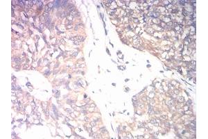 Immunohistochemical analysis of paraffin-embedded bladder cancer tissues using CD131 mouse mAb with DAB staining.