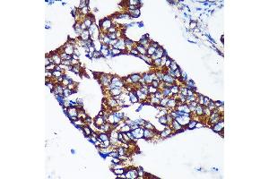Immunohistochemistry of paraffin-embedded Human colon carcinoma using EPN2 Rabbit pAb (ABIN7267002) at dilution of 1:100 (40x lens).