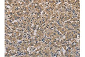 The image on the left is immunohistochemistry of paraffin-embedded Human thyroid cancer tissue using ABIN7128303(AGTRAP Antibody) at dilution 1/40, on the right is treated with fusion protein. (AGTRAP anticorps)