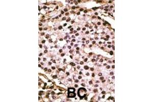 Formalin-fixed and paraffin-embedded human cancer tissue reacted with the primary antibody, which was peroxidase-conjugated to the secondary antibody, followed by DAB staining.