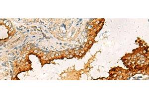 Immunohistochemistry of paraffin-embedded Human prost ate cancer tissue using PDCL Polyclonal Antibody at dilution of 1:40(x200)