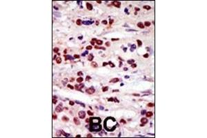 Formalin-fixed and paraffin-embedded human cancer tissue reacted with the primary antibody, which was peroxidase-conjugated to the secondary antibody, followed by AEC staining. (DRAK2 anticorps  (C-Term))