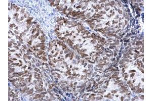 IHC-P Image FOXA1 antibody detects FOXA1 protein at nucleus on human cervical carcinoma by immunohistochemical analysis.