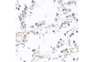 Immunohistochemistry of paraffin-embedded human gastric cancer using CASP3 antibody. (Caspase 3 anticorps  (AA 55-160))