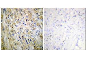 Immunohistochemical analysis of paraffin-embedded human prostate carcinoma tissue using Prostate-specific Antigen antibody (ABIN5976496). (Prostate Specific Antigen anticorps  (Internal Region))