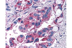 Anti-MRGPRX2 / MRGX2 antibody IHC of human Lung, Non-Small Cell Carcinoma.