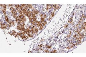 ABIN6278491 at 1/100 staining Human liver cancer tissue by IHC-P. (SCN2A anticorps  (Internal Region))