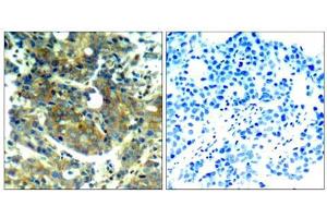 Immunohistochemical analysis of paraffin-embedded human breast carcinoma tissue, using p70 S6 Kinase (phospho-Ser411) antibody (E011269). (RPS6KB1 anticorps  (pSer411))